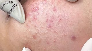 ACNE TREATMENT VU QUYNH MI Acne On Boys Chin 2024 [upl. by Direj246]