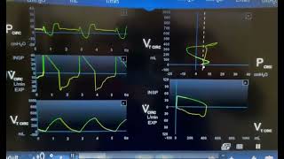 Air Hunger on Mechanical Ventilation [upl. by Drawyah672]