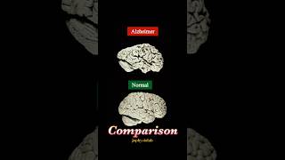 Alzheimer’s Dementia vs Normal Brain  PET scan  Neurology [upl. by Madda]