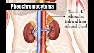 Pheochromocytoma Symptoms Pathophysiology Diagnosis and Treatment [upl. by Helbonnah931]