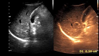 Adenomyomatosis Gall Bladder  RokitanskyAschoff sinuses [upl. by Annirak]