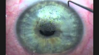 Bladeless All Laser Lasik quot In Simple Englishquot [upl. by Bleier]