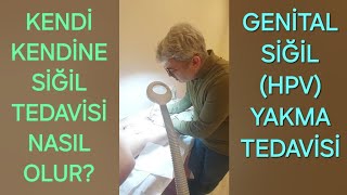 Genital Siğil HPV Neden Tekrar Eder Muayenehanede ve KENDİ KENDİNE SİĞİL TEDAVİSİ Nasıl Yapılır [upl. by Sik779]