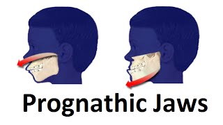 Treatment of Prognathic Jaw Jaw Pushing Forward by Prof John Mew [upl. by Eiznekam852]