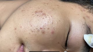 ACNE TREATMENT VU QUYNH MI Acne On Boys Chin 2024 [upl. by Willyt]