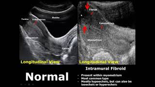 Uterus Ultrasound Normal Vs Abnormal Image Appearances Comparison  Uterine Pathologies USG [upl. by Annadiana875]