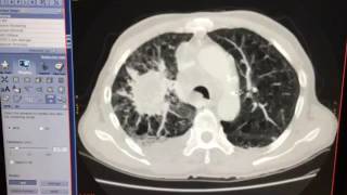 CT thorax Right lung mass with spiculated edges and effusion [upl. by Robbins]