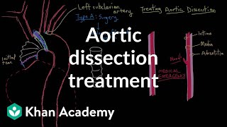 Aortic dissection treatment  Circulatory System and Disease  NCLEXRN  Khan Academy [upl. by Kylie]