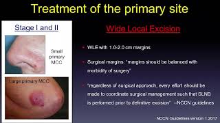 Update in Medical Treatment of Merkel Cell Carcinoma [upl. by Fishbein]