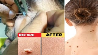 warts removal treatment and heading processموہکوں کا جڑھ سے خاتمہ [upl. by Lonee50]