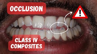 Occlusion on Class IV Composite Restorations  PDP150 [upl. by Llerret]