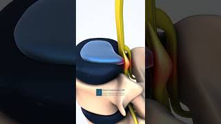 Lumbar Spine Herniated Disc Medical Animation [upl. by Laszlo]