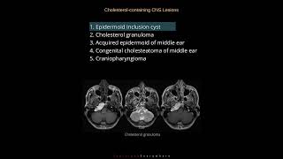 Cholesterol lesions in CNS  Radiology Tutorials  1000 cases in 100 days Case 01 [upl. by Bowyer608]