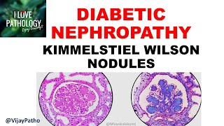 DIABETIC NEPHROPATHY Pathophysiology amp Morphology [upl. by Gabor379]