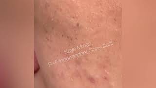 RodanFields Pore Tool For Blackhead Removal [upl. by Shum]