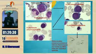 Atelier  Lecture de lhémogramme et la place du frottis sanguin M Khorassani [upl. by Einwat]