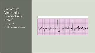 Intro to antiarrhythmics [upl. by Ameer603]