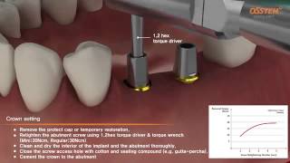 ETIII fixture with Transfer Abutment Surgical amp Prothesis [upl. by Lucilla130]