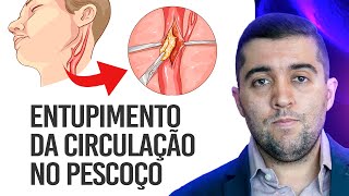 Qual risco da doença nas carótidas as artérias que levam sangue para a cabeça e o pescoço [upl. by Jegger]