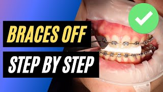 BRACES OFF  Step by step orthodontic removal [upl. by Arick]