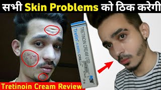 Tretinoin Cream Benefits Uses Side Effects  ट्रटीनाॅइन क्रीम Review [upl. by Ruthanne]