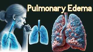 Pulmonary Edema Fluid In the Lungs Symptoms amp causes [upl. by Lang]