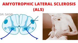 Amyotrophic Lateral Sclerosis ALS [upl. by Aliehc190]