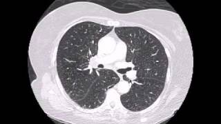 Spiculated lung tumor in background of emphysema [upl. by Bekki]