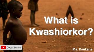 What is Kwashiorkor disease  Medical Science  General Medicine [upl. by Adiela551]