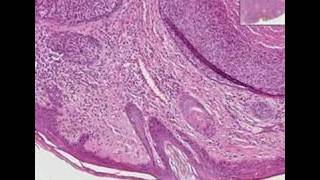 Histopathology Skin lipBasal cell carcinoma [upl. by Iatnwahs]