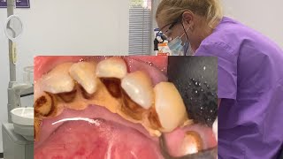 Smoker’s teeth cleaning  dental care  scaling [upl. by Cristy772]