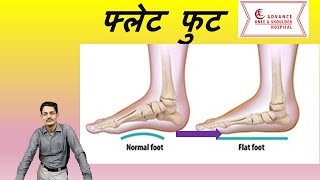 Flat Foot in Hindi फ्लैट फुट [upl. by Charley]