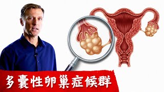 多囊性卵巢症候群PCOS 與胰島素阻抗有關自然療法柏格醫生 Dr Berg [upl. by Clarhe]