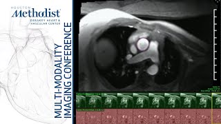 Mitral and Aortic Regurgitation Evaluation by Echo amp CMR Faza MD amp ElTallawi MD November 2 2021 [upl. by Gonick]