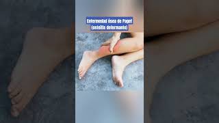 ENFERMEDAD DE PAGET DOLOR DE HUESOS [upl. by Woolson]