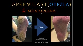 Apremilast Otezla and Keratoderma [upl. by Winfrid]