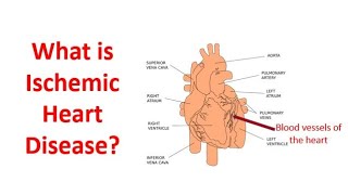 What is ischemic heart disease [upl. by Miza880]