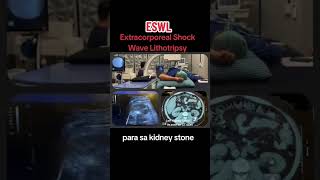 Extracorporeal Shock Wave Lithotripsy for Kidney Stone [upl. by Aneehsor]