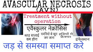 Avascular Necrosis treatment without operation by homeopathy [upl. by Llevra]