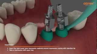 TSIII Fixture Placement amp Impression taking Pickup and Transfer Impression Copings [upl. by Adlev]