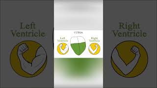 Congenitally corrected transposition of the great arteries CCTGA [upl. by Nosnehpets]