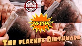 Flacky Birthmark‼️❤️ASMR‼️ [upl. by Gisele]