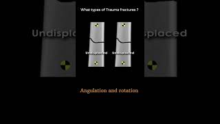 Angulation and rotation 25 Introduction to Trauma xray Fracture displacementradiologychannel007 [upl. by Akenal]