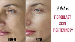 Plasma Pen Before and After  Fibroblast Before and After Treatment  Plasma Pen [upl. by Navillus202]