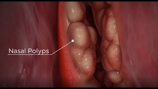 নাকের পলিপাস দূর করার উপায়Lemna Minor 200 For Nasal Polyps  nasal polyps homeopathic medicine [upl. by Sosna]