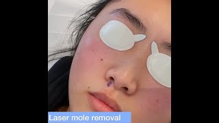 Laser Mole Removal  London Skin Clinic [upl. by Glenine]