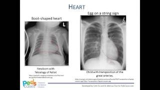 Approach to Pediatric Chest XRays [upl. by Lebasi]