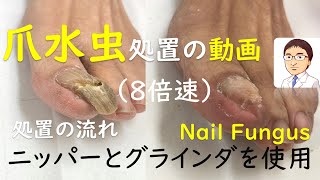 【8倍速】爪水虫（白癬）処置の動画 1分で流れを把握 巻き爪・陥入爪治療の相談室 Treatment of tinea unguium  Nail fungus [upl. by Nalat]