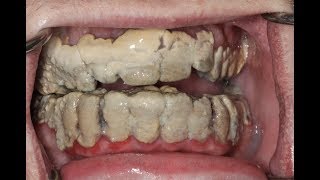 20 Years Without Brushing Teeth 😦  Calculus Removal [upl. by Bunns]