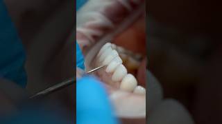 Get Perfect Teeth with Porcelain Veneers asmr dentalcosmeticturkey smilemakeover [upl. by Alick]